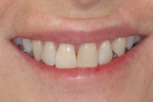 04 whitening non-vital after