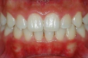 Crowding and Anterior Crossbite — After