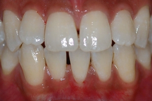 Spacing and Missing Tooth — Before