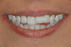 Open Bite, Crowding, and Tipped Front Tooth  Before
