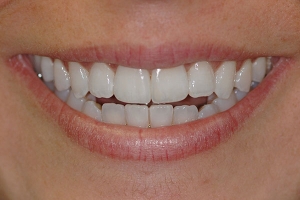 Open Bite, Crowding, and Tipped Front Tooth — After