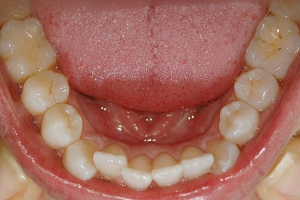 Crowding and Tipped Incisor — Before