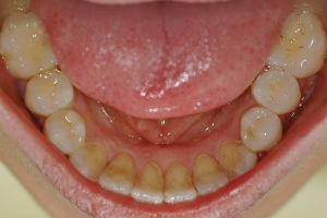 Crowding and Tipped Incisor — After