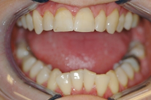 Overerupted Lower Incisors and Deep Bite — Before