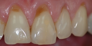 Brown Stains On Teeth Near Gum Line TeethWalls