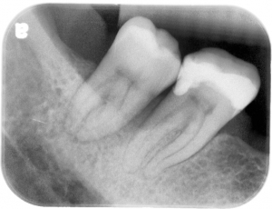 x-ray of a tooth that needs extraction
