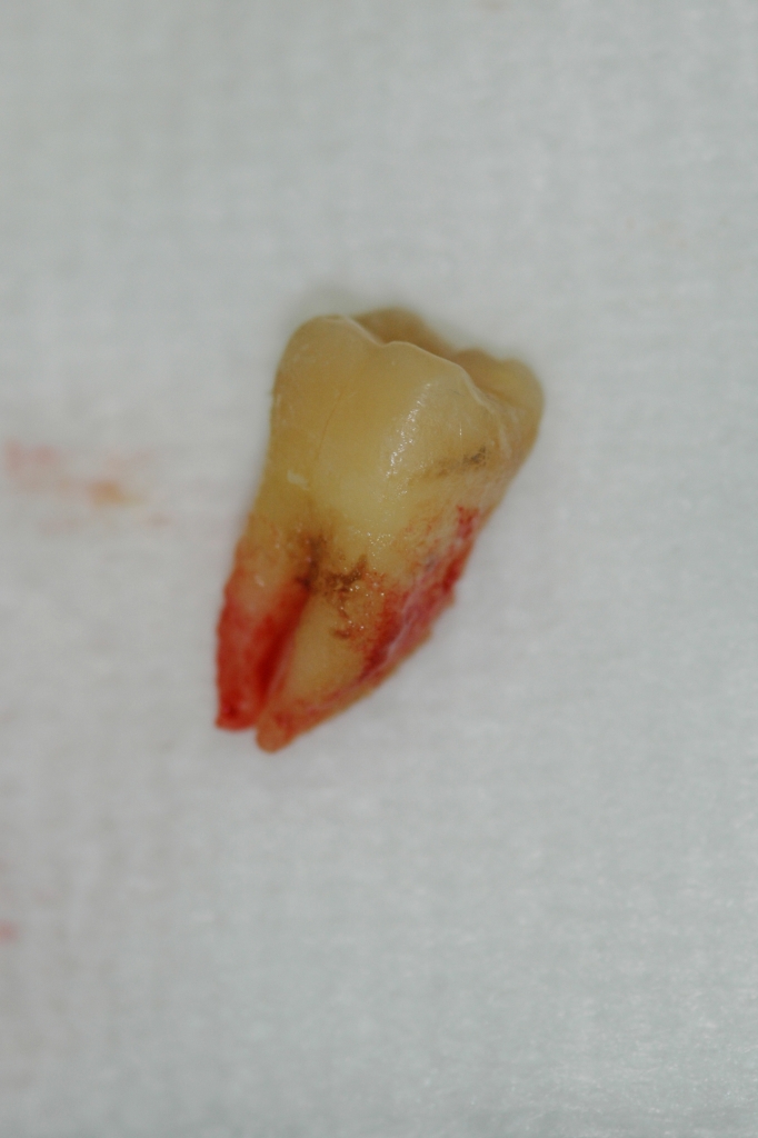tooth extraction image 4 of 4