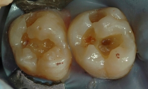 Fillings example 2