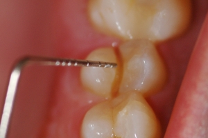 Clenching causes tooth fracture