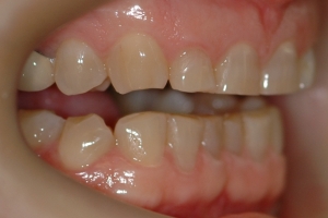 Night Grinding effect on teeth