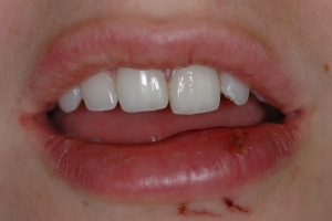 Tooth injury without mouthguard