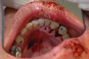 Mouth injury without mouthguard
