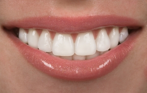 Aldente Dentistry veneers