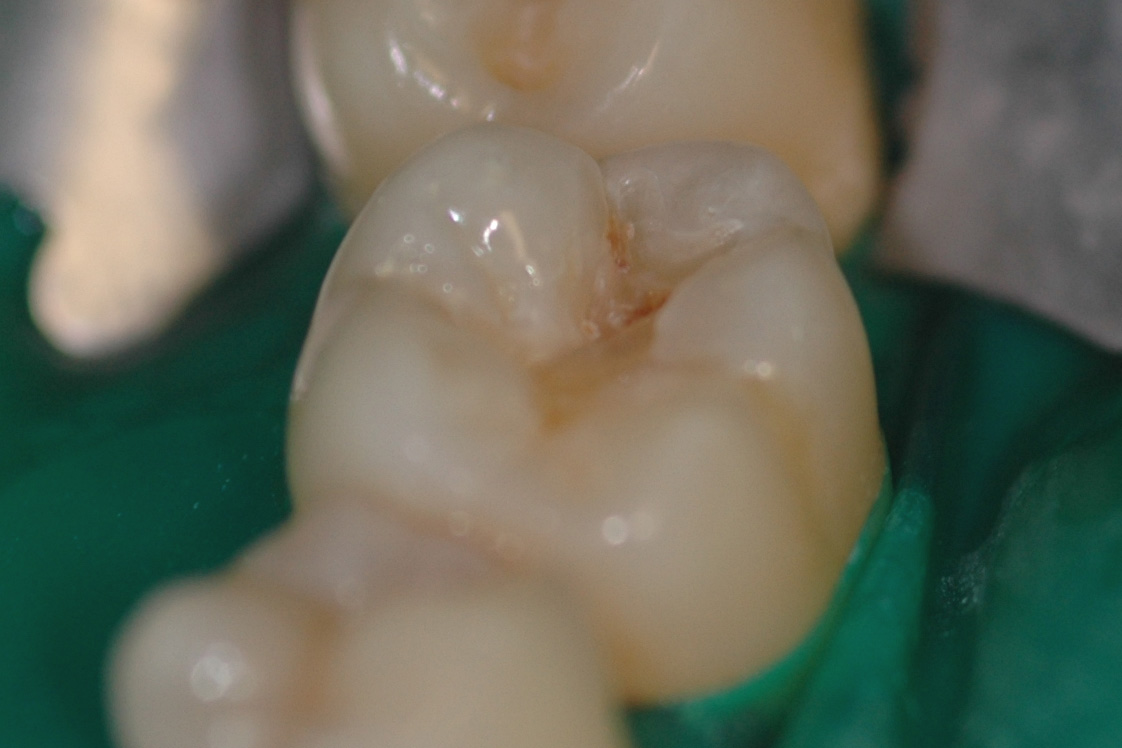 aldente teeth