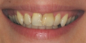 Veneers and Crowns — Before