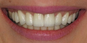 Veneers and Crowns — After