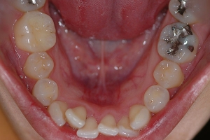 Invisalign — Before