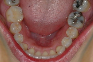 Invisalign — After