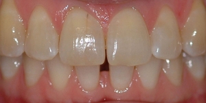 Invisalign — Before