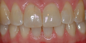 Invisalign — After