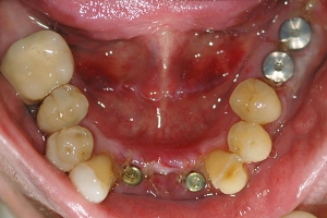 Implants, Crowns, Bridges — Before