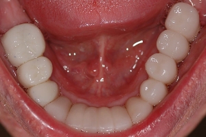 Implants, Crowns, Bridges — After